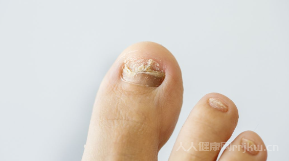灰指甲用什么药品最有效