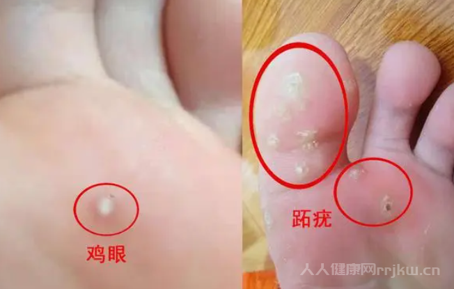 什么是鸡眼及治疗方法