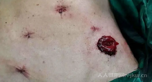 直肠癌千万别动手术