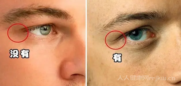 什么叫眼尾沟