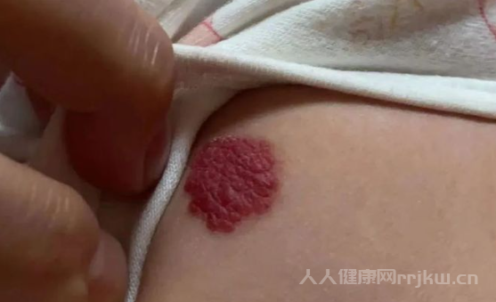 动脉瘤严重吗