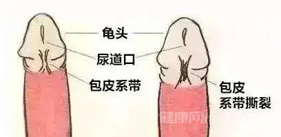 没割包茎可以性生活吗