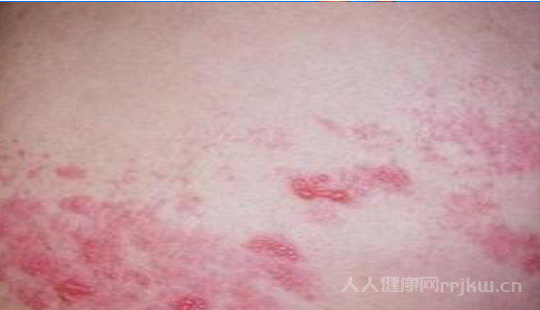 如何预防系统性红斑狼疮的发生？
