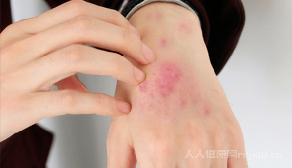 系统性红斑狼疮是什么病,系统性红斑狼疮早期症状有哪些图3