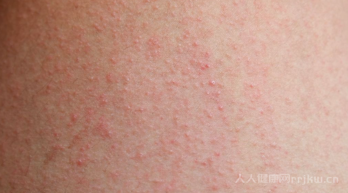 2025年治疗荨麻疹有哪些偏方